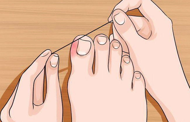 Cách giảm sưng khóe chân