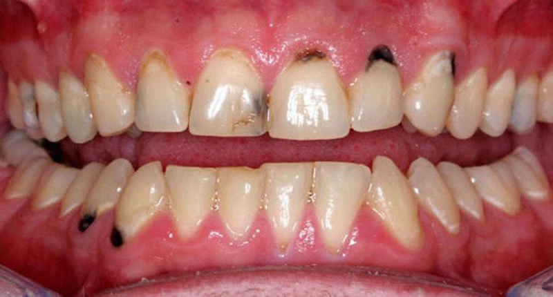 Cách loại bỏ đốm đen ở răng