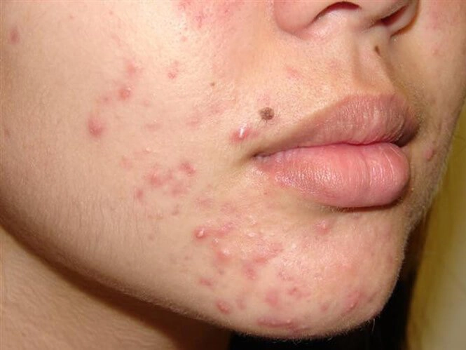 Cách nào điều trị nhọt tại nhà?