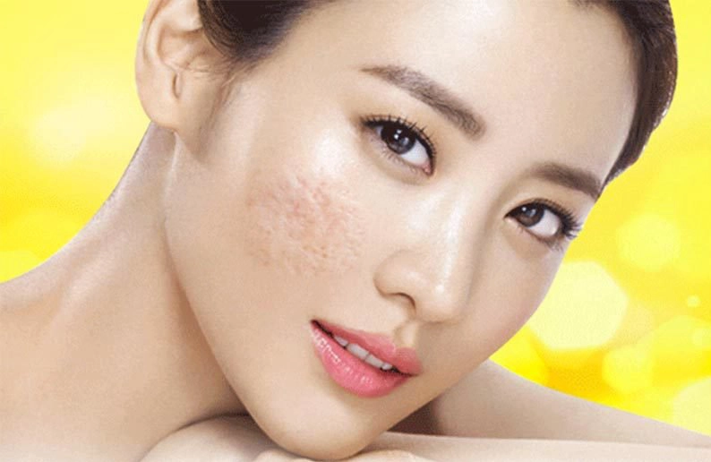 Cách trị lành sẹo hiệu quả có thể thực hiện tại nhà