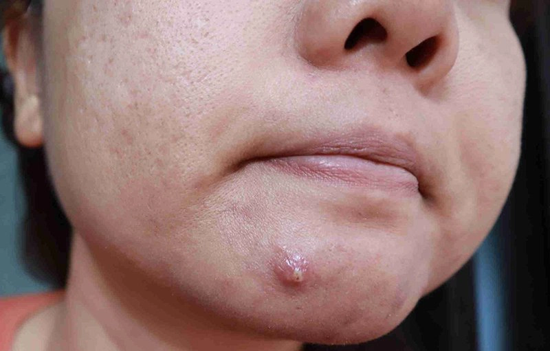 Cách trị mụn bọc sưng đỏ tại nhà an toàn