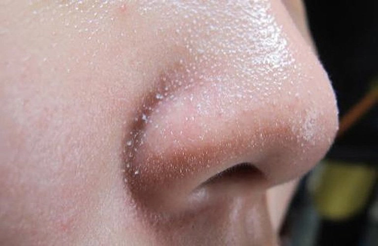Cách trị mụn cám ở mũi an toàn