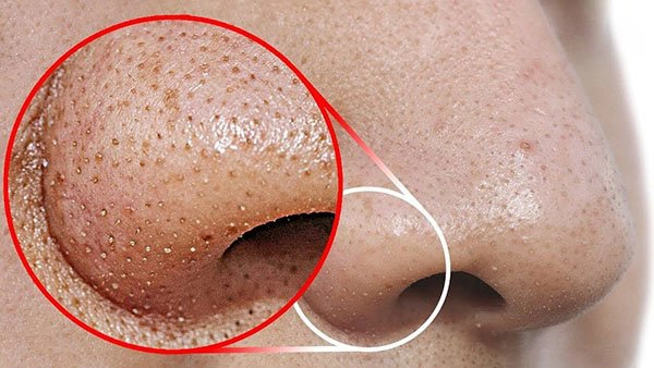 Cách trị mụn đầu đen ở mũi hiệu quả tại nhà
