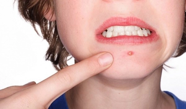 Cách trị mụn đầu đinh dân gian