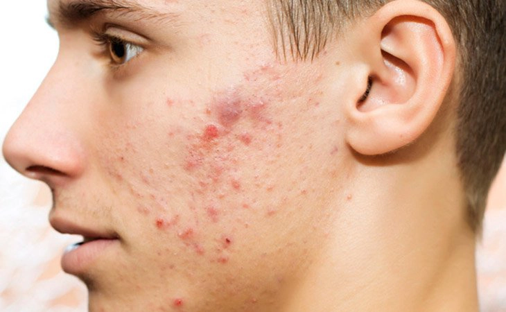 Cách trị mụn nội tiết ở nam giới