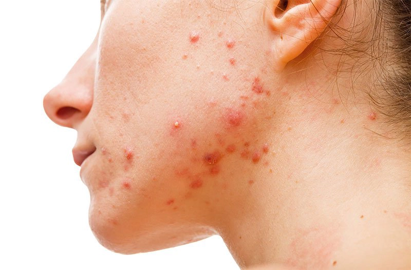 Cách trị mụn nội tiết sau sinh