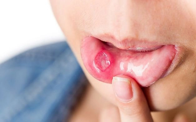 Cách trị nhiệt miệng nhanh khỏi, an toàn