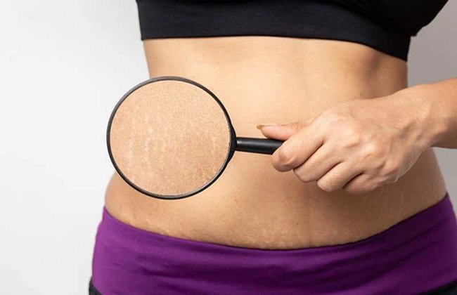 Cách trị rạn da trắng, đỏ khi tăng cân