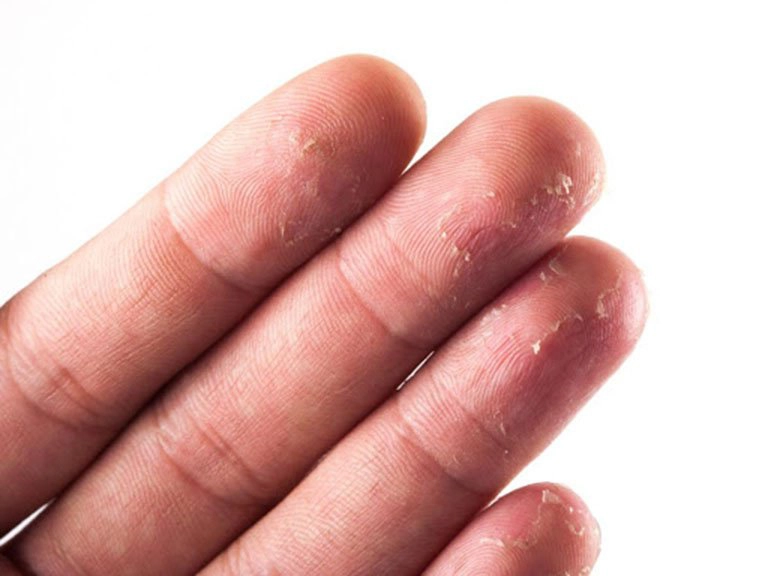 Cách xử lý khi bị tróc da tay