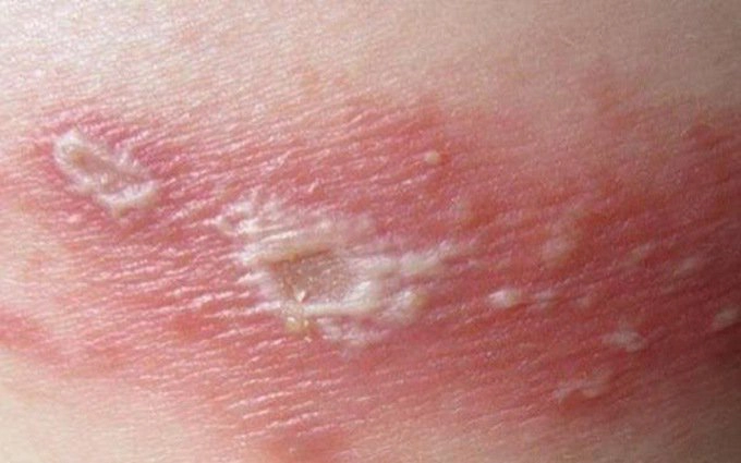 Cảm giác ngứa sau điều trị khỏi Zona thần kinh là sao?