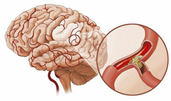 Cận lâm sàng và điều trị huyết khối tĩnh mạch não