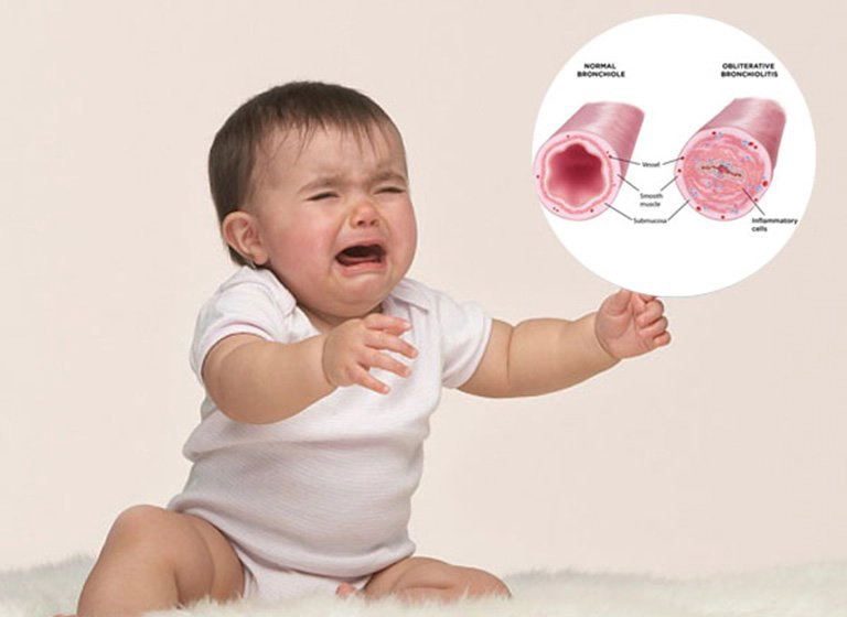 Cẩn trọng trẻ bị viêm tiểu phế quản bội nhiễm