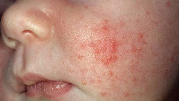 Cảnh giác các loại mụn ở trẻ sơ sinh