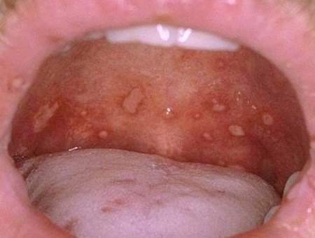 Cảnh giác loét miệng trong tay chân miệng ở trẻ