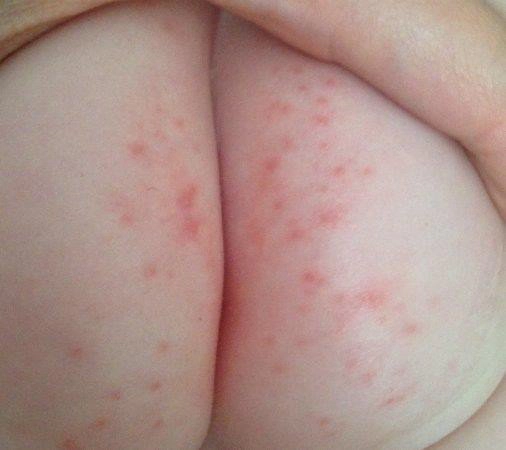 Cảnh giác trẻ bị hăm da do tiêu chảy