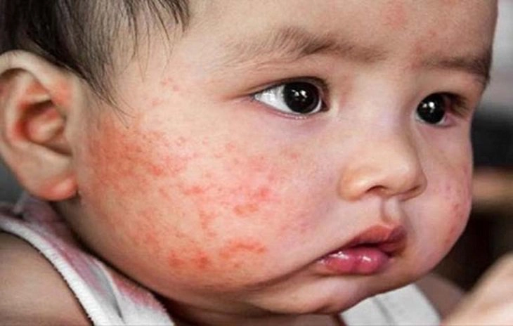 Cảnh giác viêm da cơ địa ở trẻ em khi giao mùa