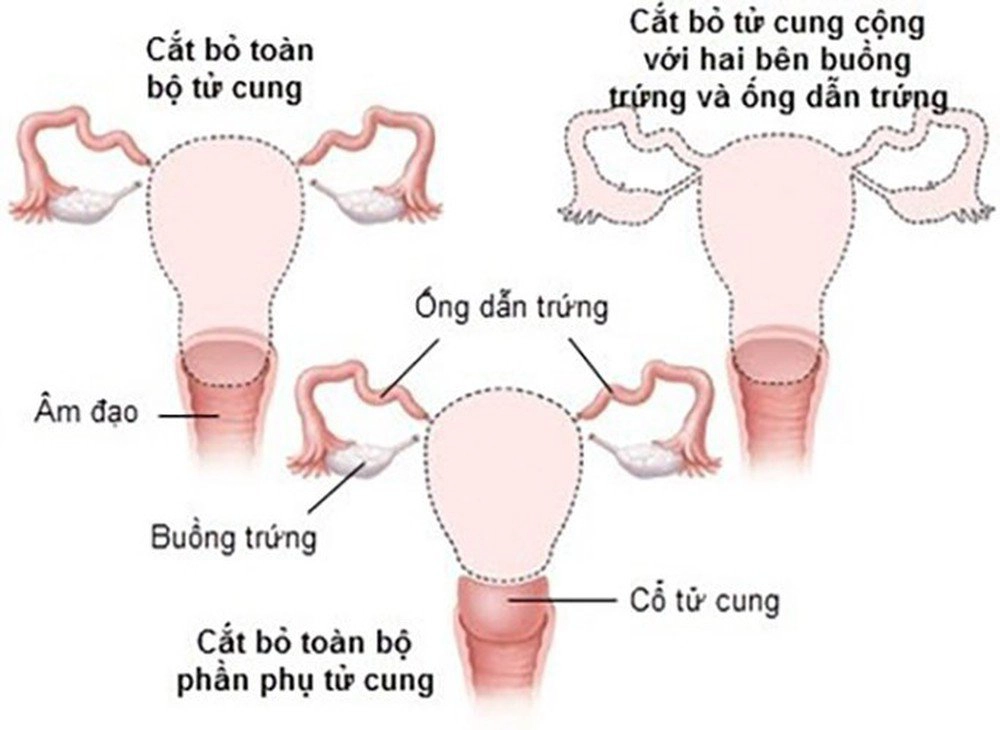 Cắt tử cung hoàn toàn khiến cơ thể bạn thay đổi thế nào?