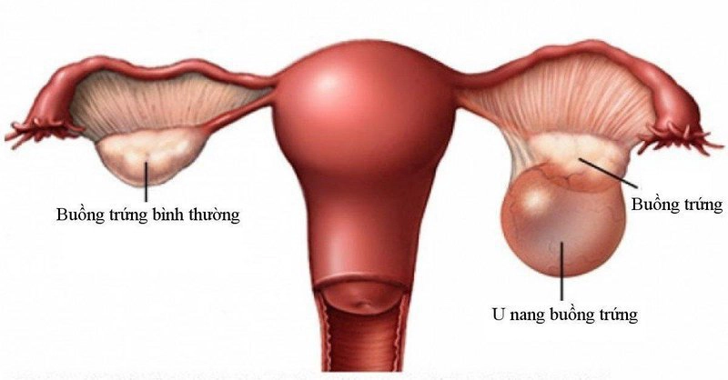 Chăm sóc bệnh nhân sau mổ u nang buồng trứng