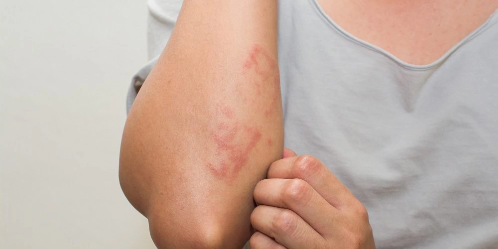 Chăm sóc da khi bệnh zona thần kinh