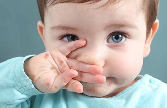Chăm sóc da, tắm cho bé khi bị tay chân miệng