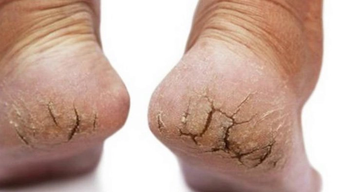 Chăm sóc và chữa nứt gót chân tại nhà