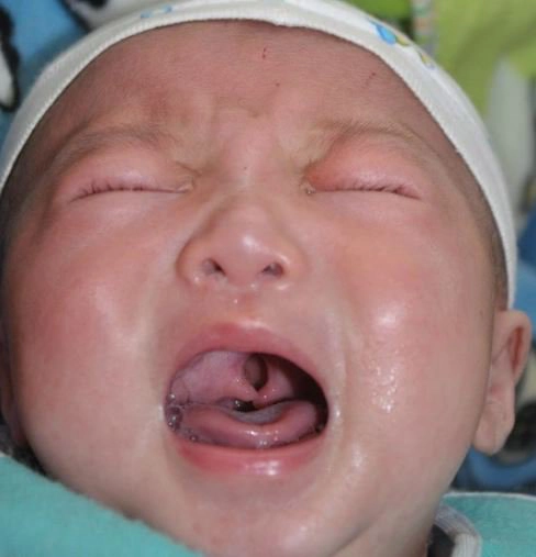 Chăm sóc và điều trị cho trẻ sơ sinh bị hở vòm họng