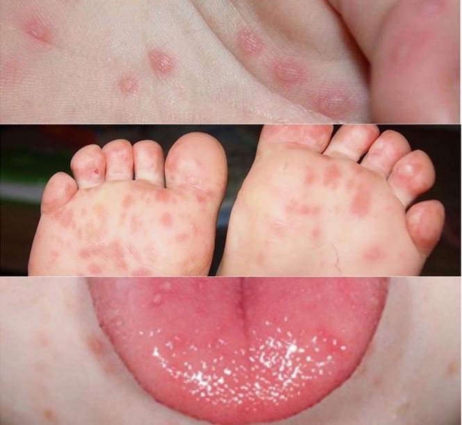 Chẩn đoán sớm bệnh tay chân miệng