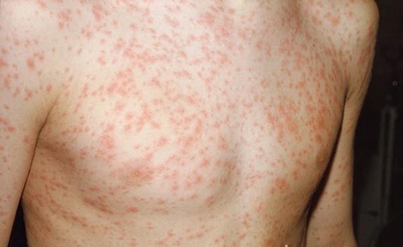 Chẩn đoán và điều trị rubella bẩm sinh