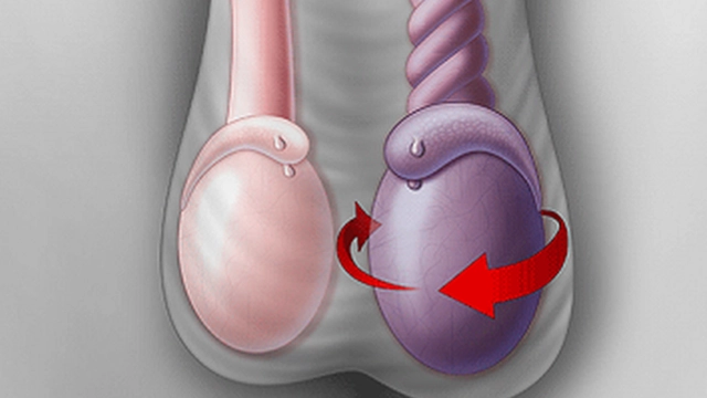 Chẩn đoán và điều trị xoắn tinh hoàn