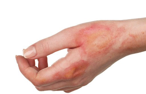 Chảy mủ chỗ ghép da do bỏng sau 3 tuần có sao không?