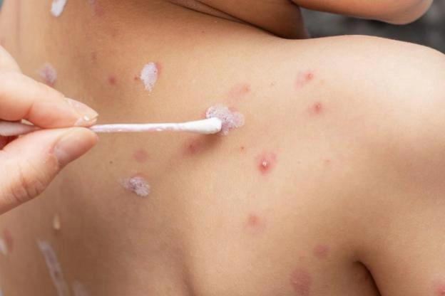Chữa bệnh thuỷ đậu bằng cách nào?