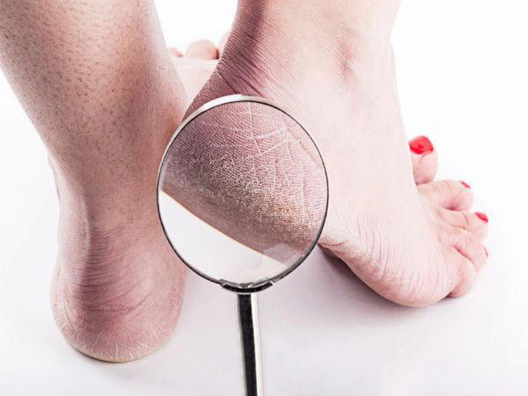 Chữa lành, chăm sóc gót chân nứt nẻ lâu ngày