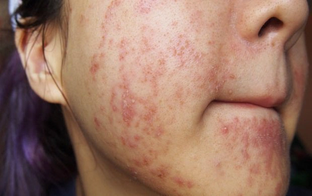 Chữa mụn trứng cá tuổi dậy thì như thế nào?