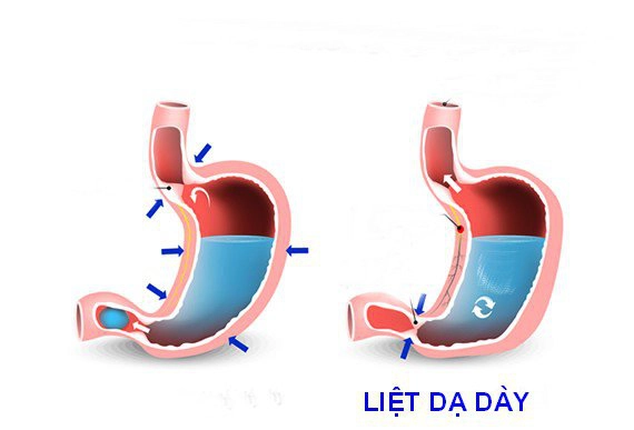 Chứng liệt dạ dày vô căn và bệnh lý thần kinh cơ