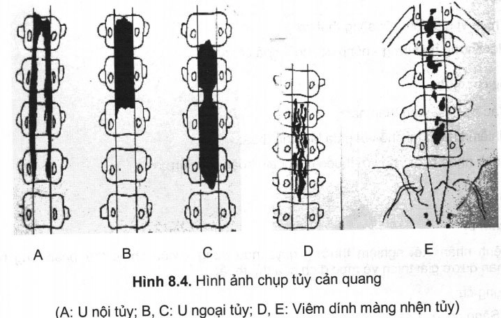 Chụp tủy sống cản quang có thể chẩn đoán bệnh gì?
