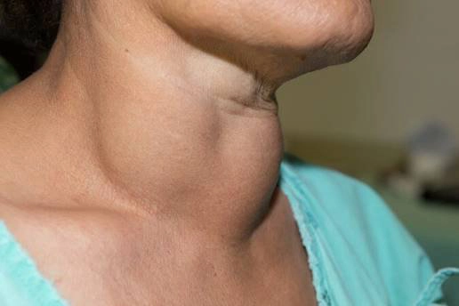 Có 10 dấu hiệu này cần phải nghĩ ngay tới bệnh lý tuyến giáp