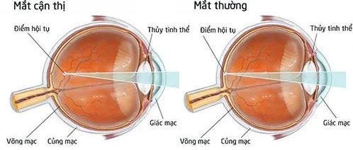 Có cách chữa cận 1 mắt hiệu quả nào?