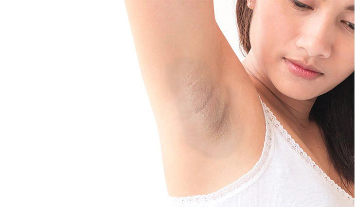 Có cách nào trị thâm nách không?