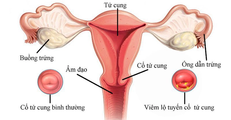 Có cần điều trị viêm lộ tuyến cổ tử cung khi mang thai?