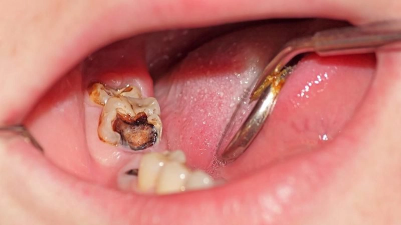Có nên nhổ răng hàm bị sâu?