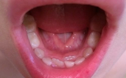 Có nên nhổ răng mọc lẫy?