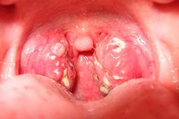 Có nhiều u nang ở họng điều trị thế nào?