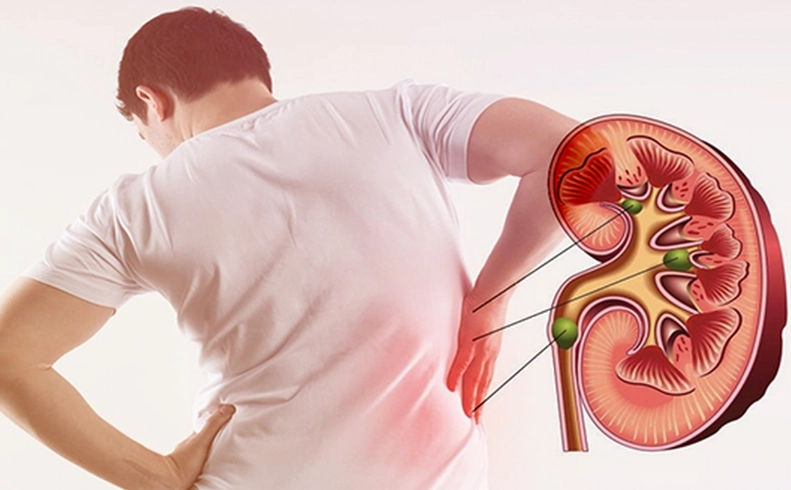 Có thể điều trị sỏi thận bằng thuốc nam?