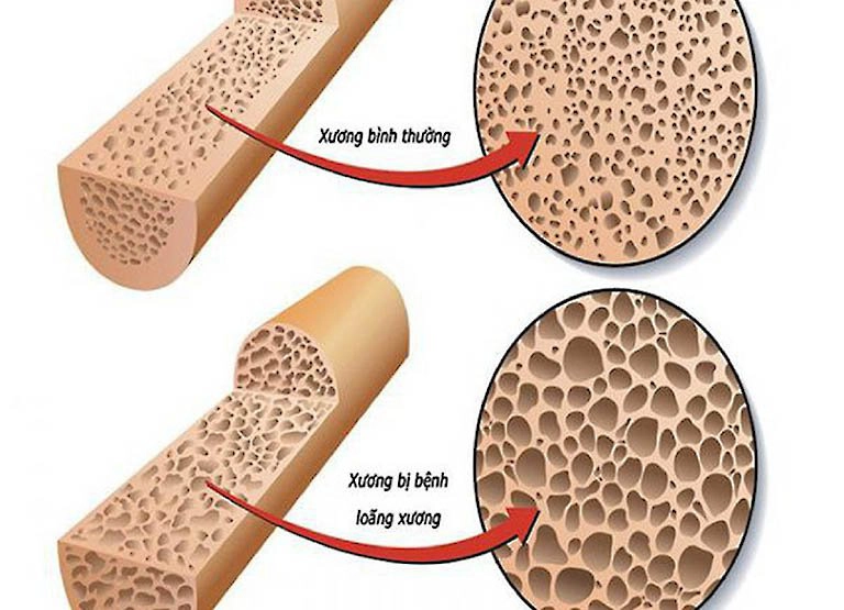 Cơ thể thiếu canxi có những biểu hiện gì?