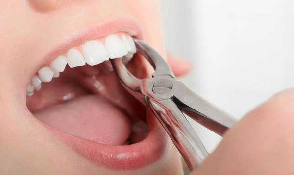 Có thể trồng răng sau khi nhổ răng hàm dưới 2 năm được không?