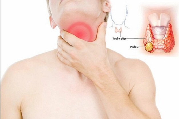 Cường giáp nên ăn gì, kiêng gì?