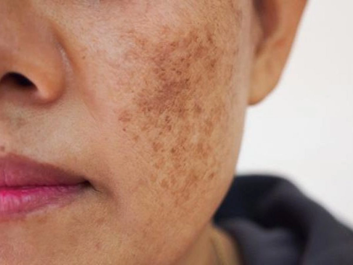 Da bị sạm đen- Nguyên nhân và cách chữa