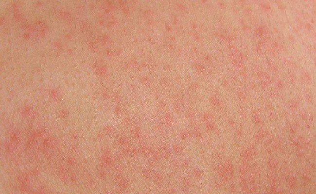 Da vẫn mẩn đỏ khi mắc sốt xuất huyết ngày thứ 10 có sao không?