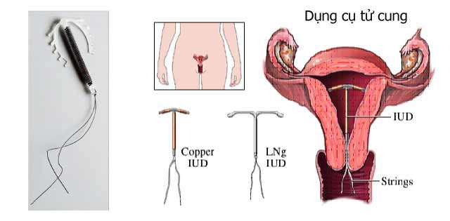 Đặt và tháo dụng cụ tử cung tránh thai