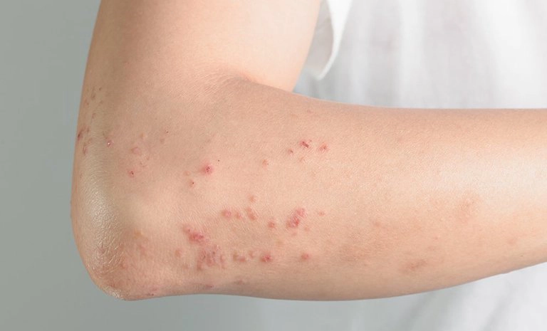 Dấu hiệu bệnh dị ứng không thể kiểm soát